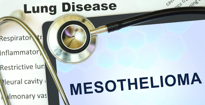 The Role of a Mesothelioma Lawyer in Your Asbestos Case